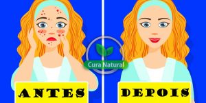 remédios caseiros para eliminar acne cística