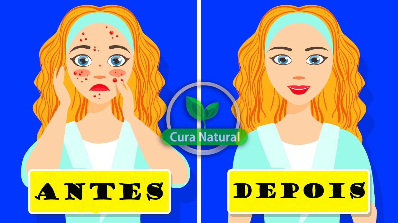 remédios caseiros para eliminar acne cística