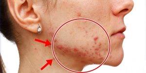 como eliminar a acne