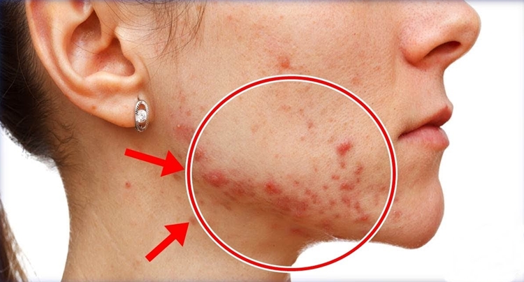 como eliminar a acne
