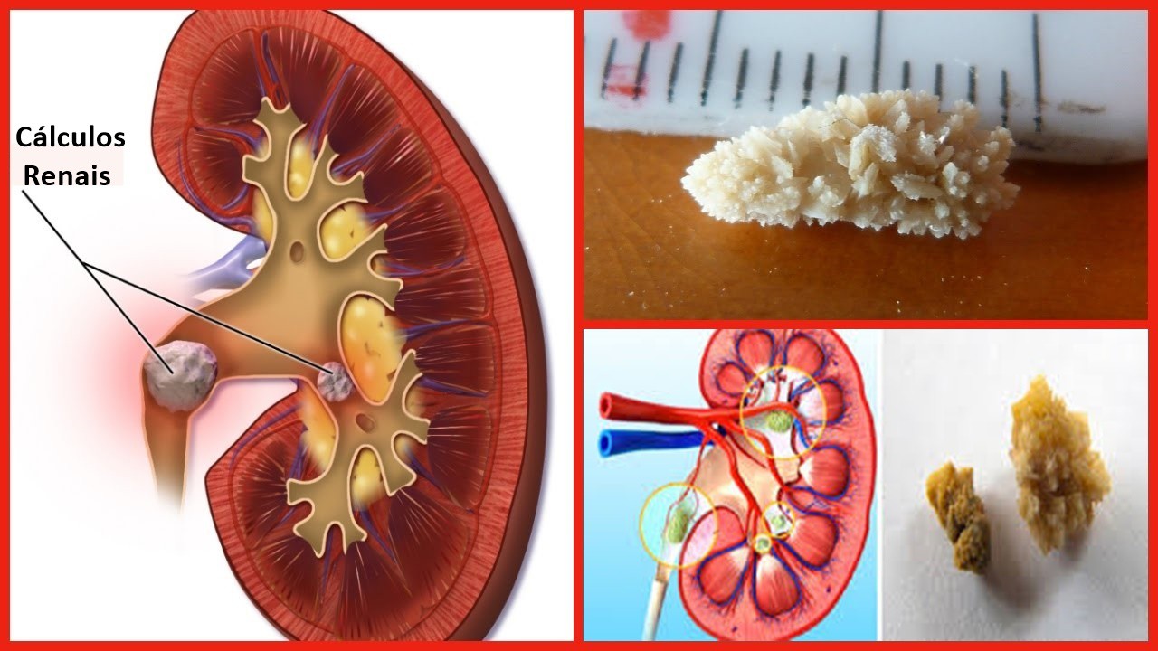 eliminar cálculos renais