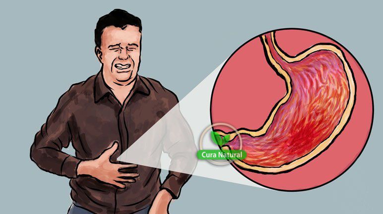 causas, sintomas e tratamentos de gastrite