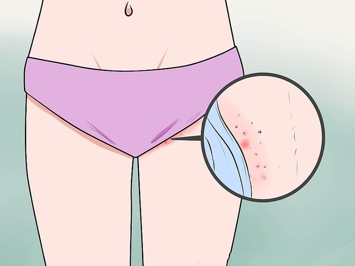 receita caseira para eliminar de vez a coceira na vagina