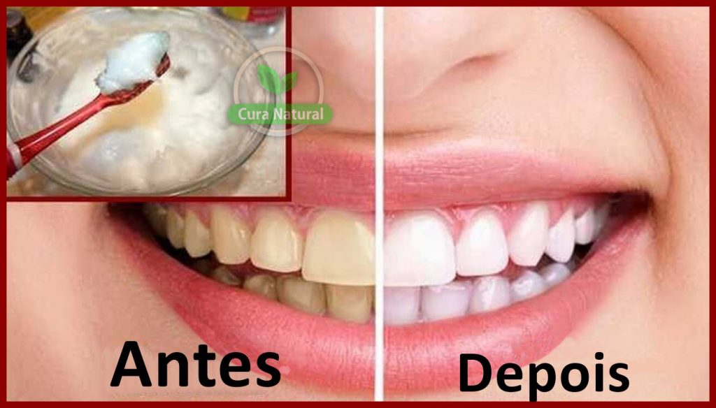 Sonhar Com Dente Amarelo De Outra Pessoa Como clarear dentes amarelos: como fazer, dicas e receitas | Cura Natural