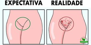 receita caseira para depilar a virilha sem sofrimento