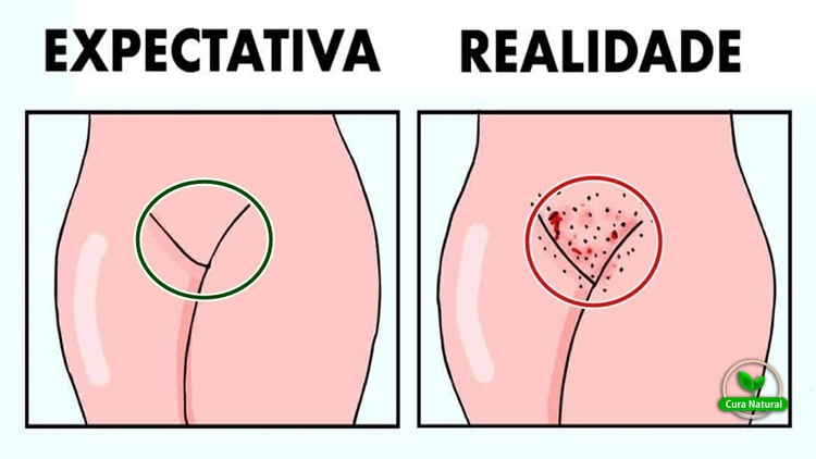 receita caseira para depilar a virilha sem sofrimento