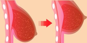 levantar os seios sem cirurgia