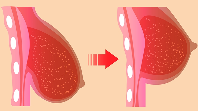 levantar os seios sem cirurgia