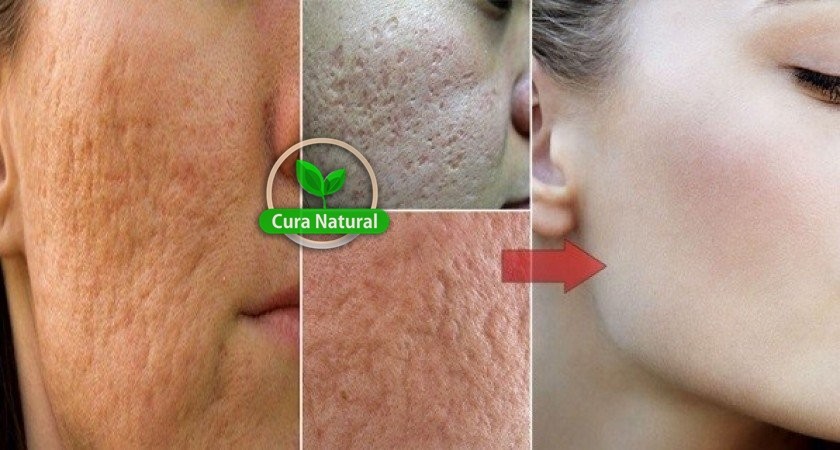 Receitas caseiras para eliminar as marcas de acne: como fazer e dicas