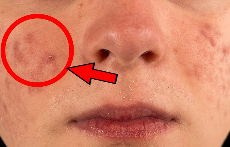 marcas de acne