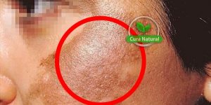 Como eliminar o melasma naturalmente em casa