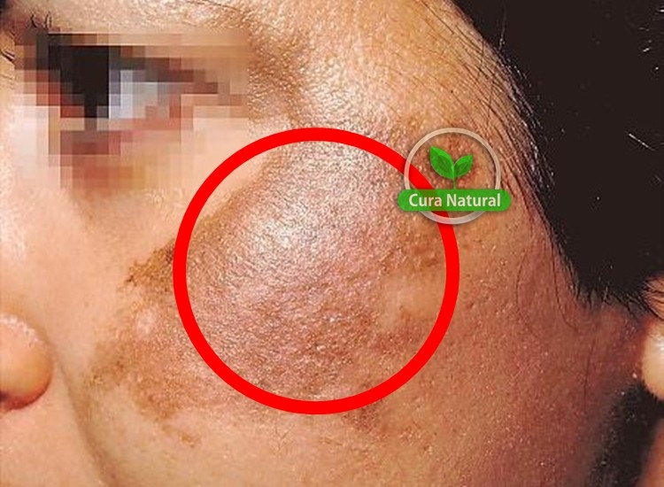 Como eliminar o melasma naturalmente em casa