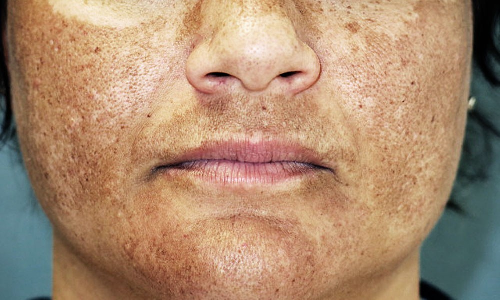 Como eliminar o melasma naturalmente em casa: como usar, dicas e receitas