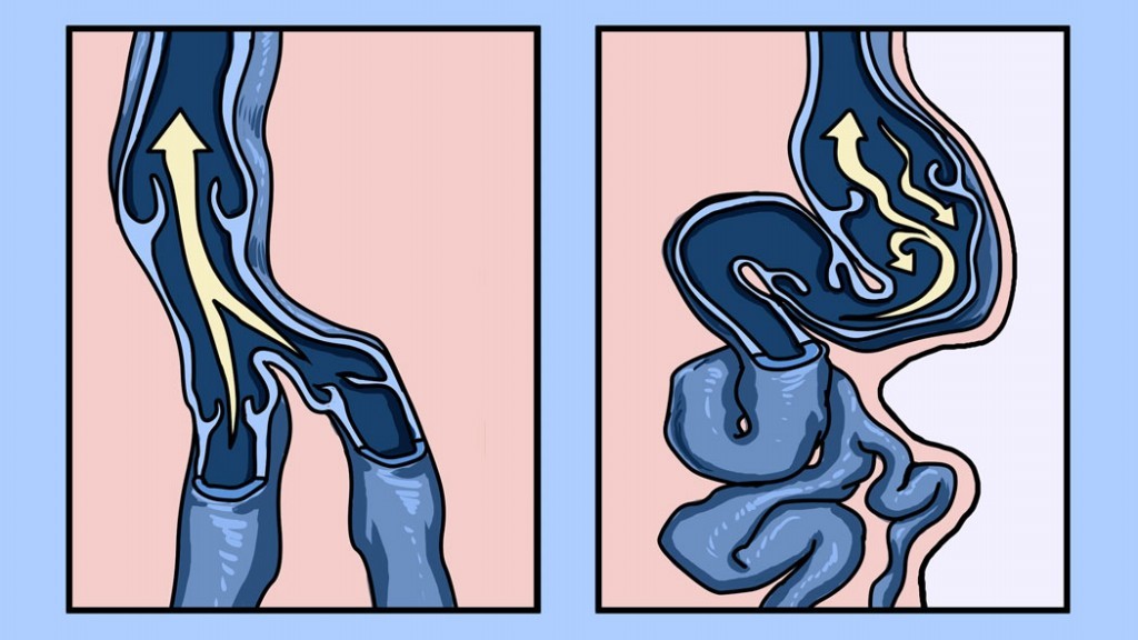 Eliminar varizes de forma natural: como fazer, dicas e receitas