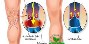 remédio caseiro para eliminar varizes naturalmente