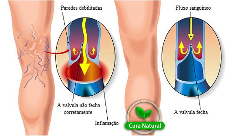 remédio caseiro para eliminar varizes naturalmente