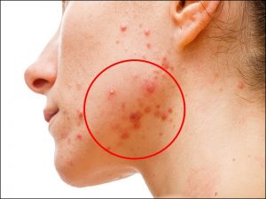 10 receitas com vinagre de maçã para tratar acne que todos usam