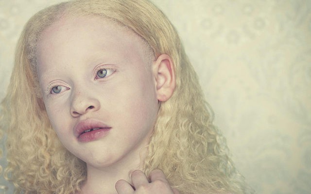 Albinismo: o que é, causas, sintomas e tratamentos