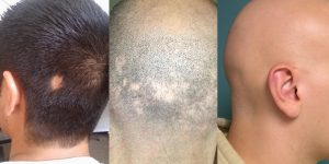 primeiros sinais de alopecia e como prevenir