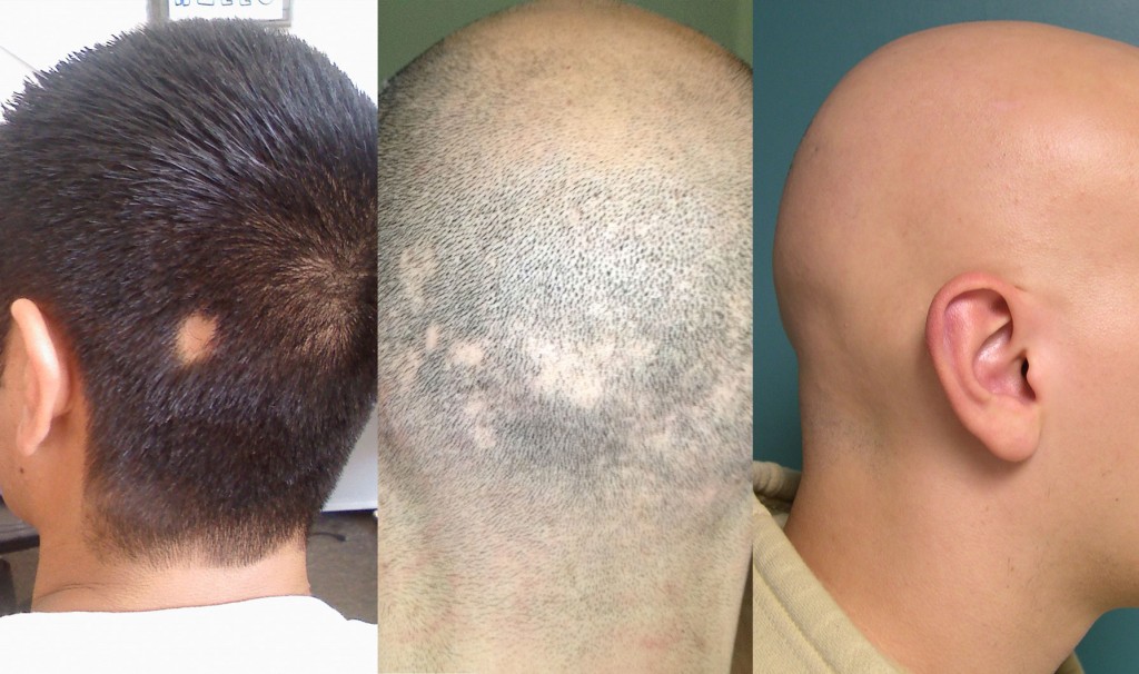 primeiros sinais de alopecia e como prevenir