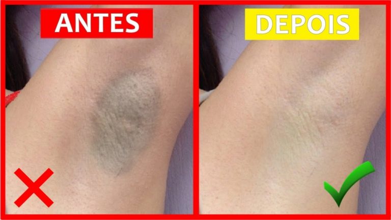 8 receitas caseiras para clarear as axilas escuras naturalmente | Cura ...