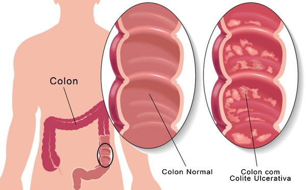 tratar a colite ulcerativa com remédios caseiros
