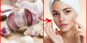 como tratar a acne com apenas 1 ingrediente