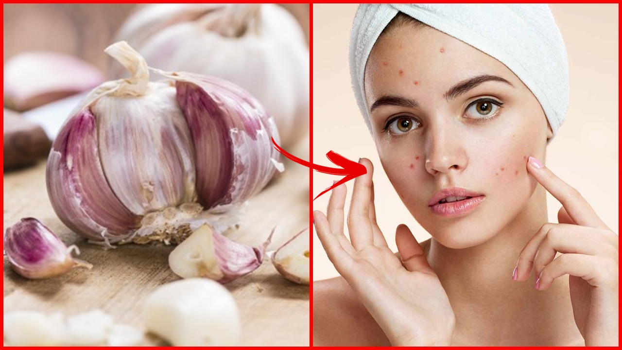 como tratar a acne com apenas 1 ingrediente