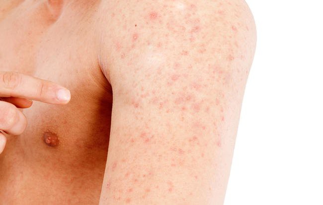 Dermatite atópica: o que é, causas, sintomas e tratamentos