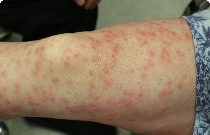 11 tipos e sintomas da dermatite que você não conhece