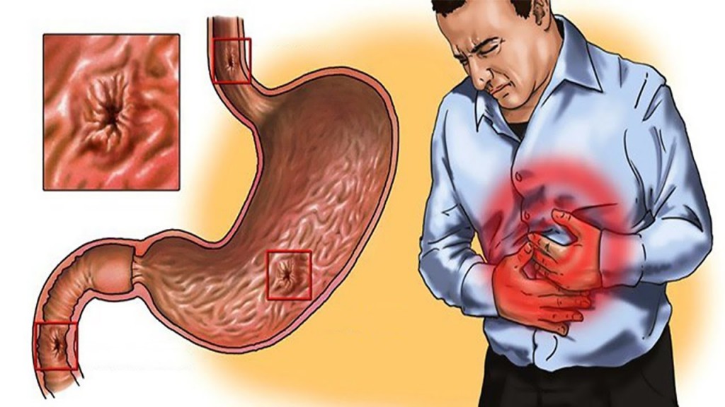 Dieta para gastrite: o que comer, que não comer e dicas