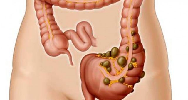 Diverticulite: o que é, causas, sintomas e tratamentos