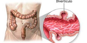 diverticulose o que e