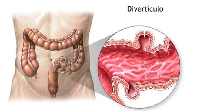 diverticulose o que e