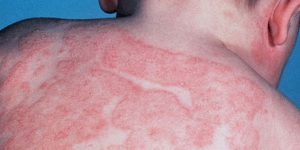 eczema atópico