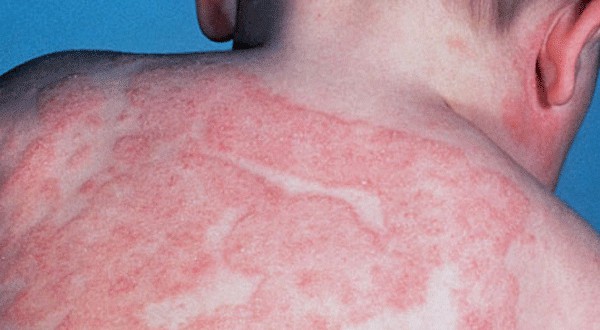 eczema atópico