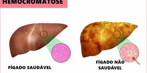 hemocromatose o que e