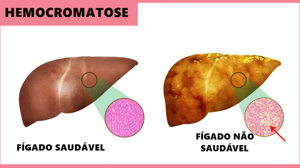 hemocromatose o que e