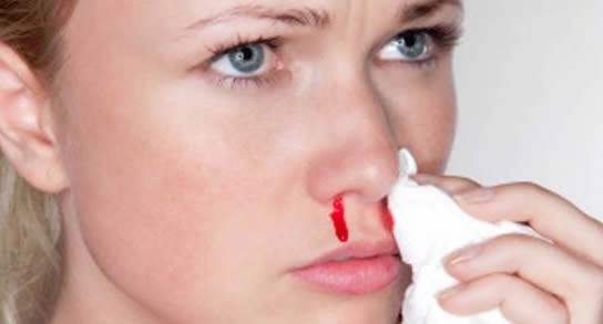 hemorragia nasal causas
