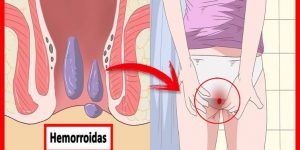 dicas para eliminar hemorroidas durante a gravidez