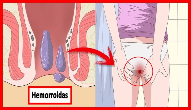 dicas para eliminar hemorroidas durante a gravidez