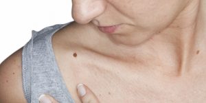 sintomas e sinais que caracterizam o melanoma