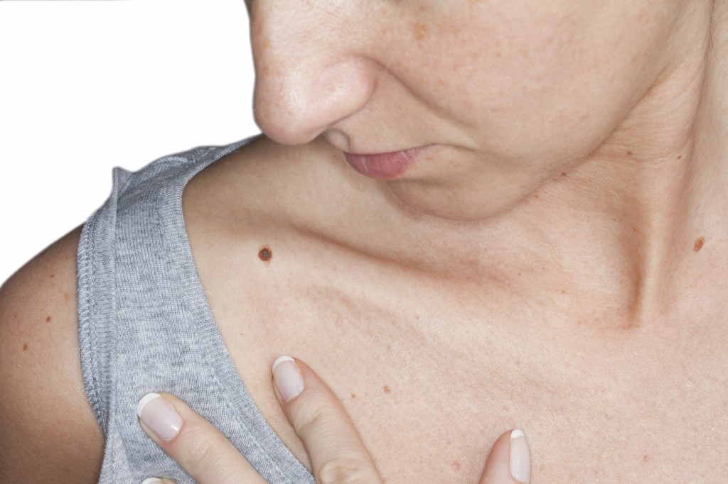sintomas e sinais que caracterizam o melanoma