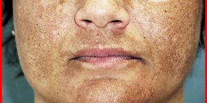 melasma