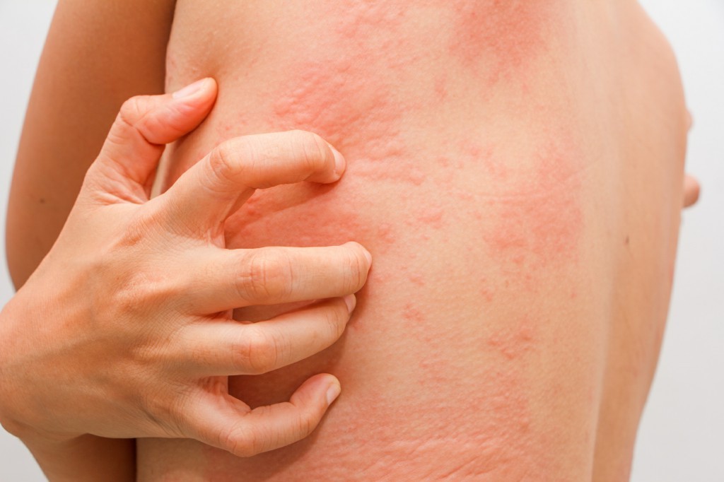 Remédios caseiros para aliviar os sintomas da alergia: dicas e receitas