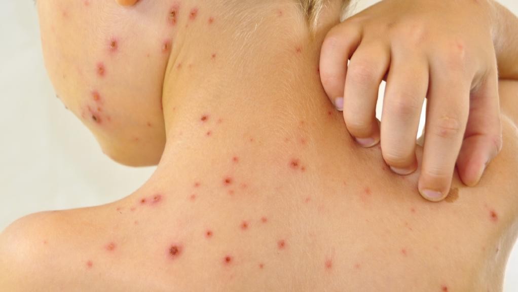 Remédios caseiros para remover cicatrizes de varíola: dicas e receitas