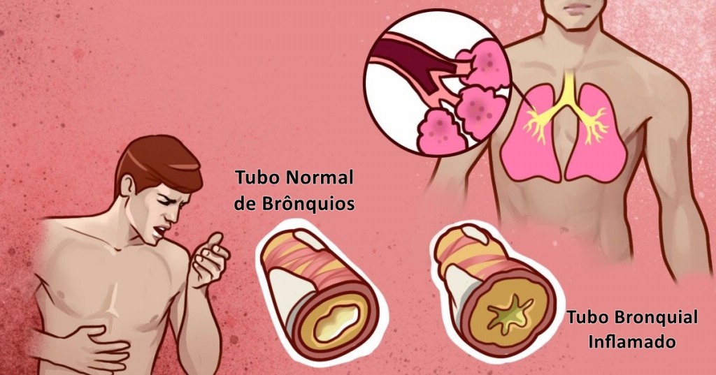 Remédios caseiros para eliminar catarro do peito: dicas e receitas