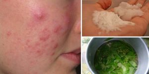 remedios caseiros para tratar acne cistica