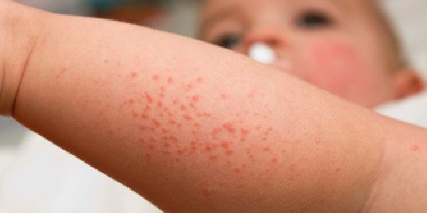 Remédios naturais para tratar a dermatite: como fazer, dicas e receitas