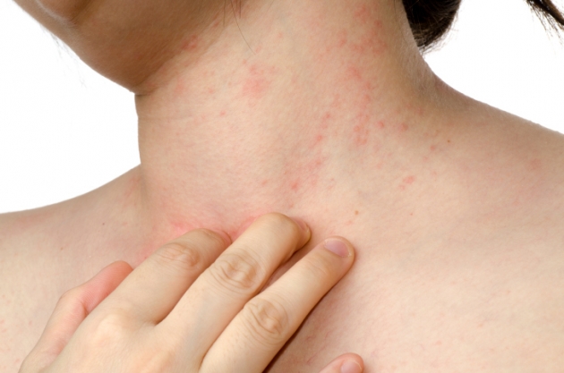 Remédios naturais para se livrar de cicatrizes eczema: receitas e dicas
